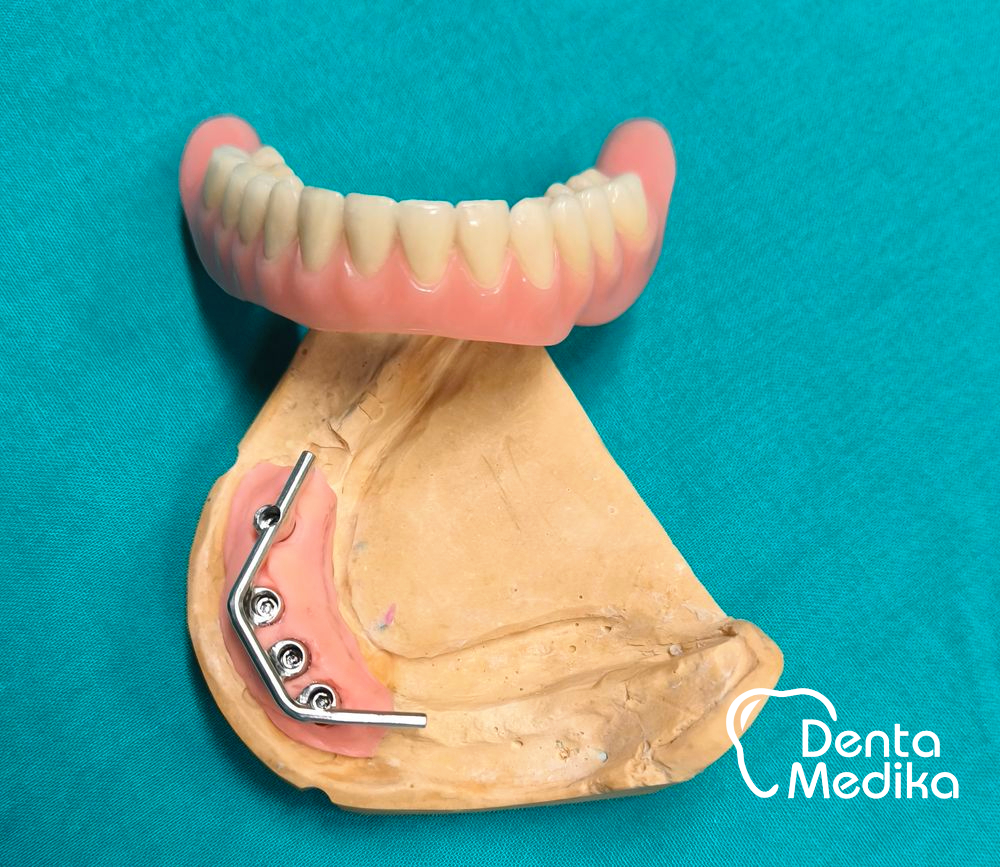 Třmenová hybridní náhrada na implantátech pro bezzubou čelist 3